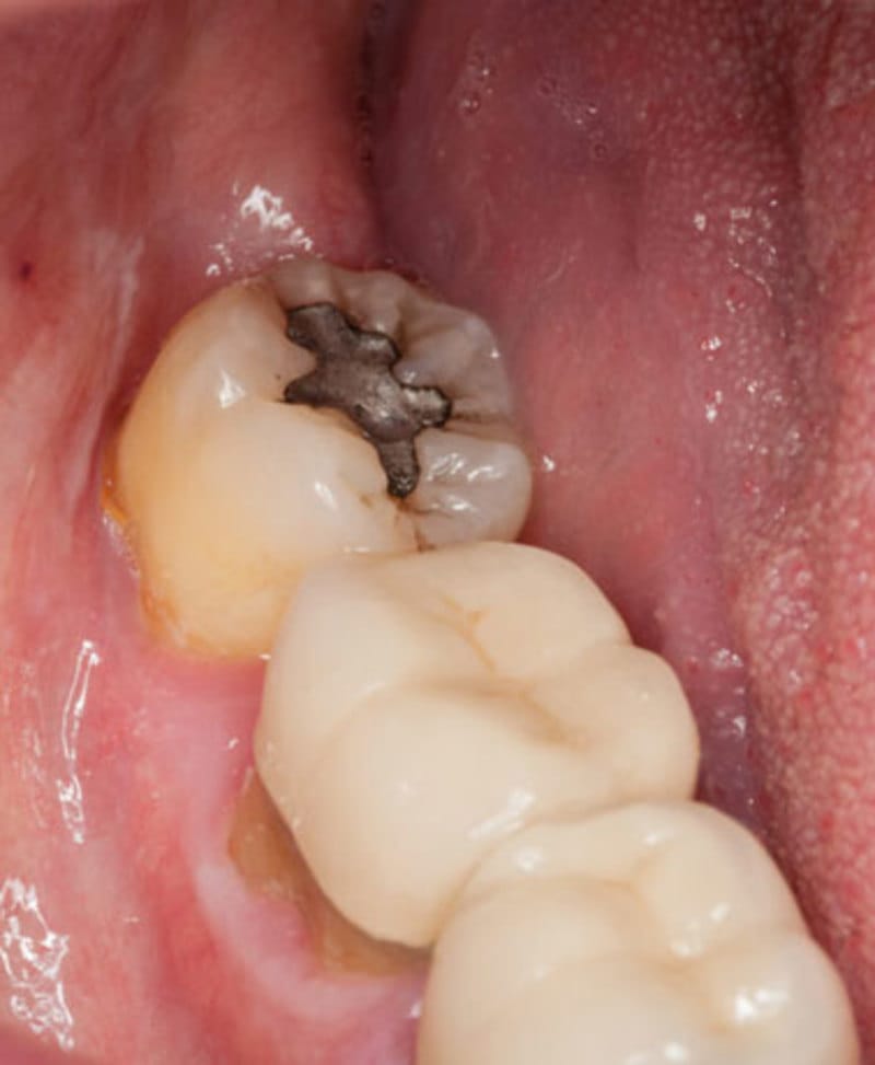 Cavity and tooth decay
