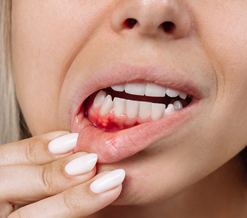Woman with bleeding gums