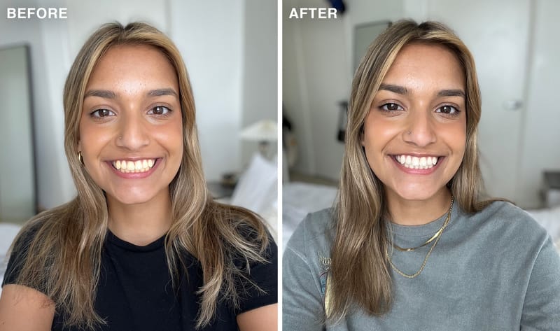 Before and after of a woman with white teeth after using Laughland teeth whitening