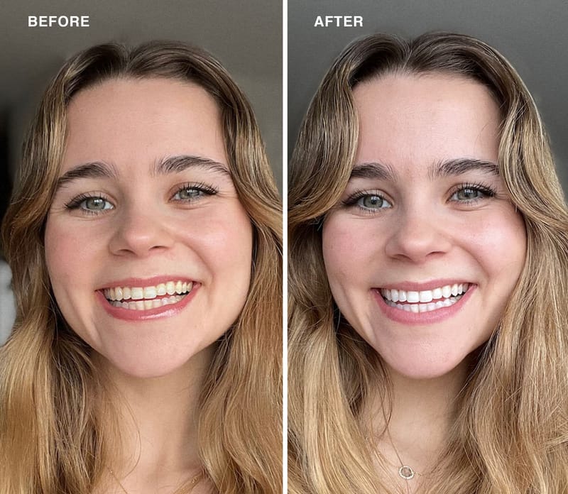 Before and after of a woman who used Laughland teeth whitening