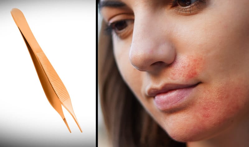 Woman's irritated skin after tweezing