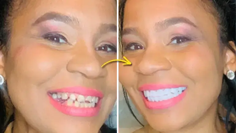 7 Reasons Why 100,000+ People Are Skipping The Dentist And Choosing These “Snap-On Smiles” Instead