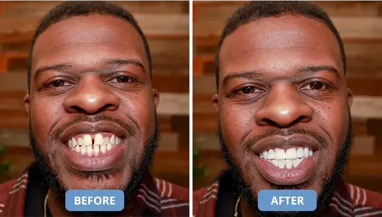 7 Reasons Why 100,000+ People Are Skipping The Dentist And Choosing These “Snap-On Smiles” Instead