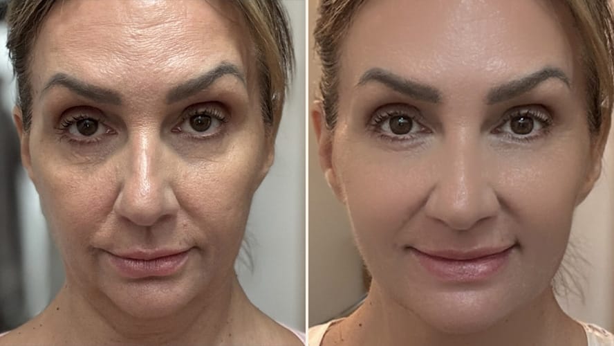 Last minute holiday gift idea – Renewa EyeLift